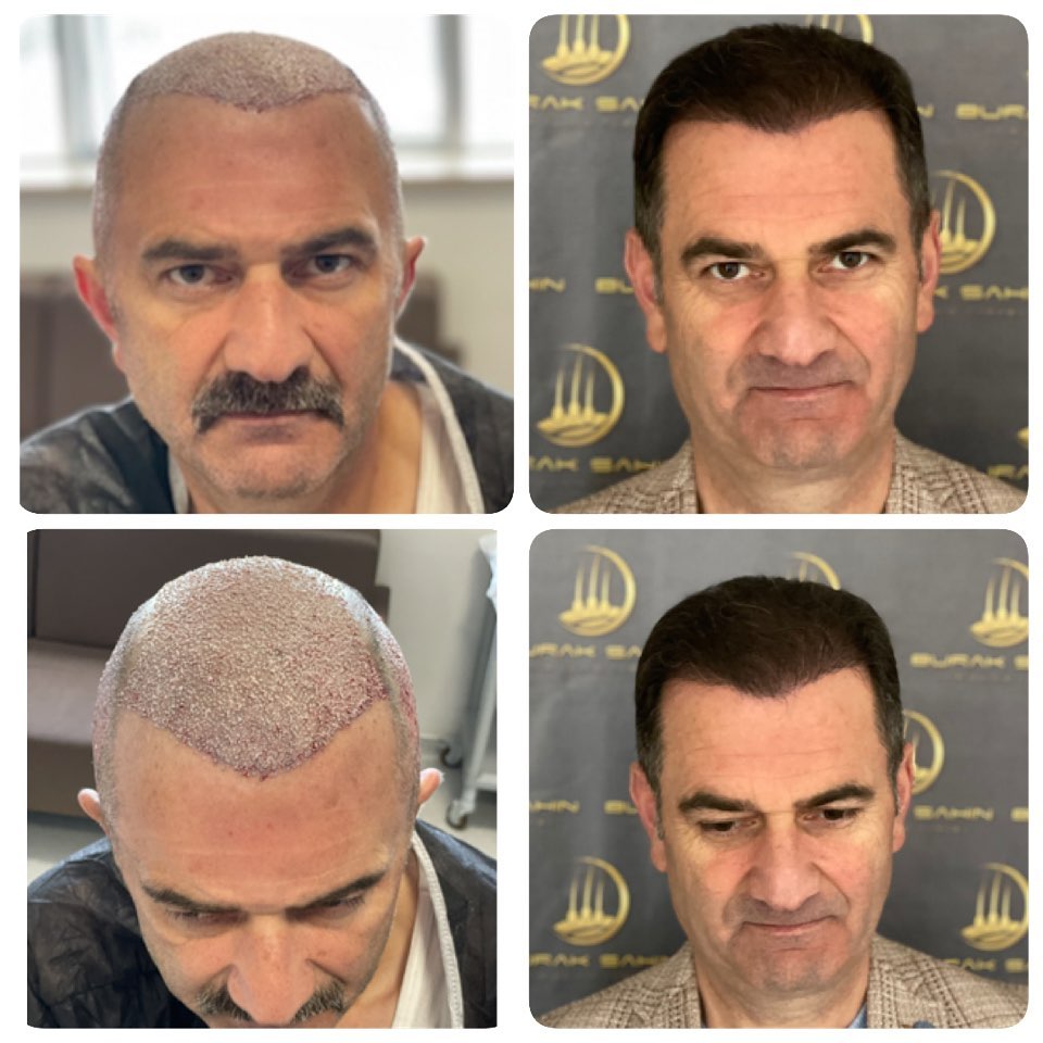 hair transplant cost