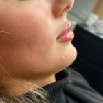 lip fillers